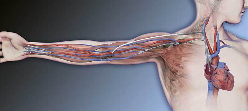 HeRO® Graft